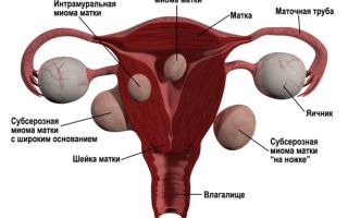 Чага при миоме матки: отзывы, рецепты, рекомендации и противопоказания